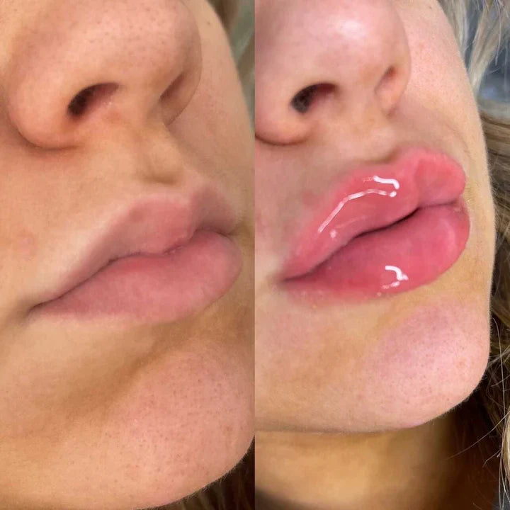 Plump It! No Needles Lip Filler Kit Original